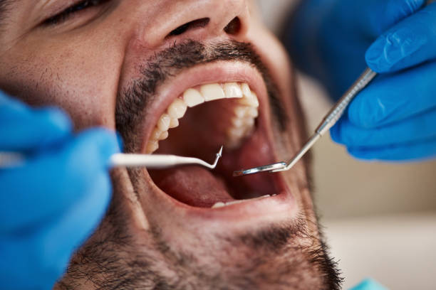 Best Emergency Dental Care for Abscessed Tooth in Carey, OH